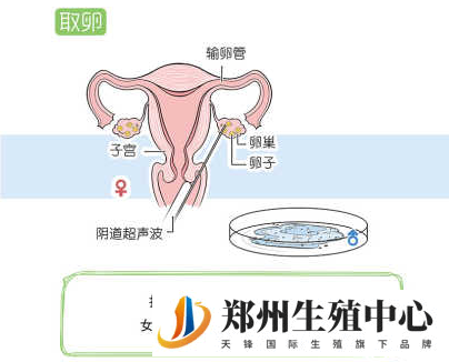 取卵取精过程