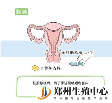 试管婴儿胚胎移植