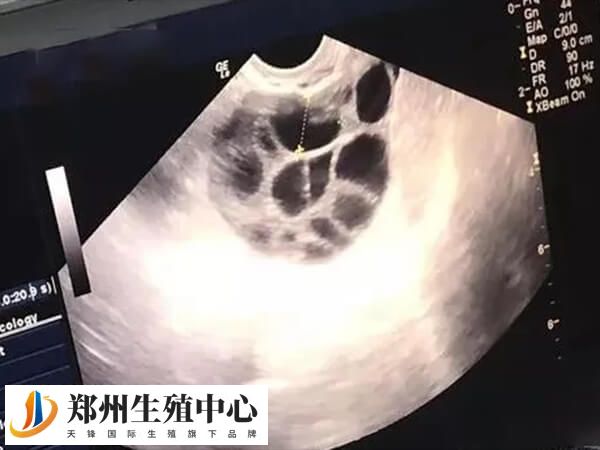 取卵数量与促排方案有一定关系