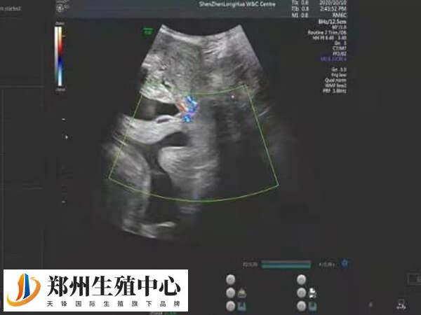 试管婴儿9周多了安不安全